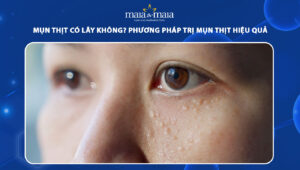 mụn thịt có lây không