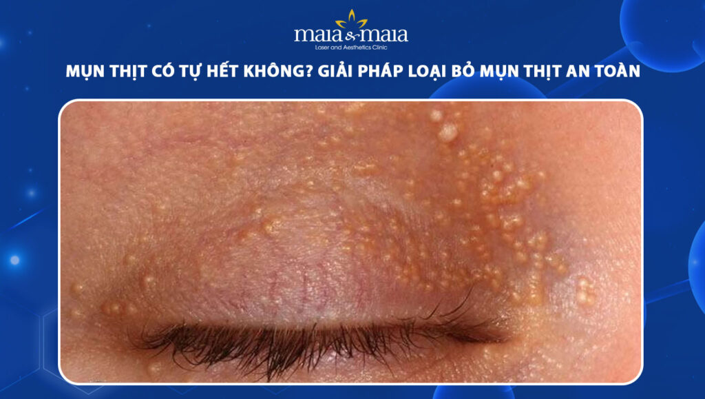 mụn thịt có tự hết không