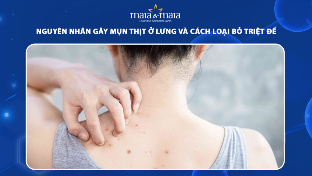 mụn thịt ở lưng