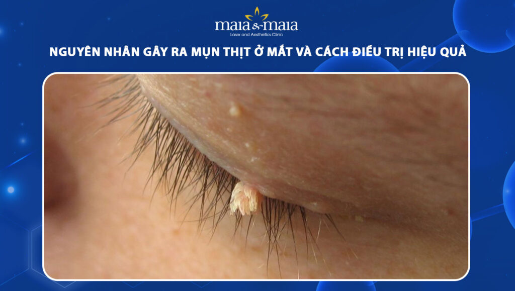 4. Cách Điều Trị Mụn Thịt Ở Mắt Hiệu Quả