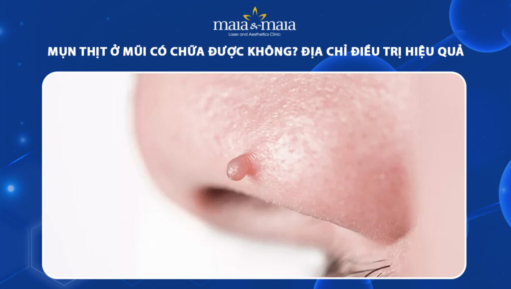 Mụn thịt ở mũi có chữa được không? Địa chỉ điều trị mụn thịt hiệu quả hàng đầu 1 mụn thịt ở mũi