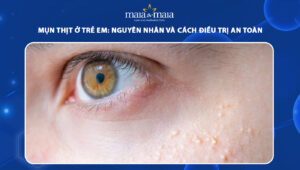 mụn thịt ở trẻ em