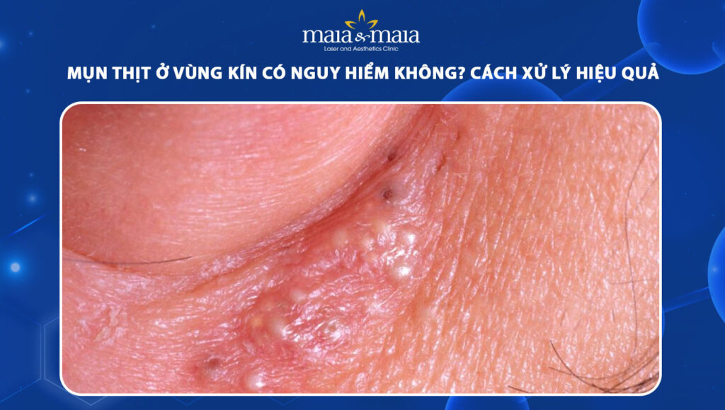 mụn thịt ở vùng kín