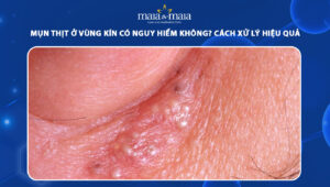 mụn thịt ở vùng kín