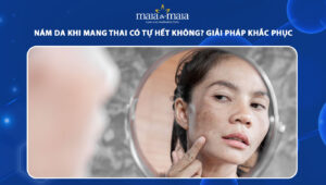 nám da khi mang thai