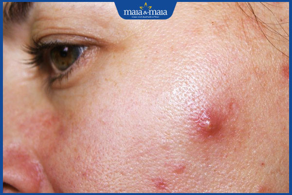 Không nặn mụn có tự hết không? Thời điểm vàng để nặn mụn 2 nổi mụn bọc trên má