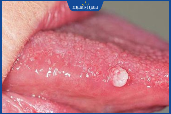 Lưỡi nổi mụn thịt là dấu hiệu của bệnh gì? Cách điều trị 2 nốt mụn thịt ở lưỡi