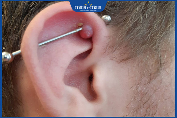 Sẹo lồi khi bấm lỗ tai: Nguyên nhân và cách điều trị 2 sẹo lồi bấm lỗ tai