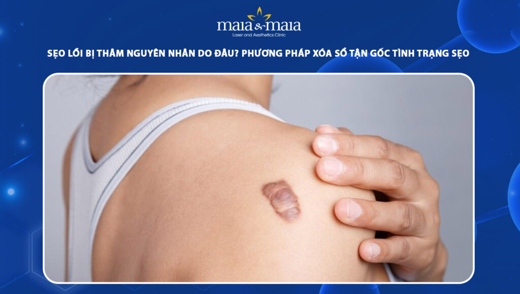 sẹo lồi bị thâm