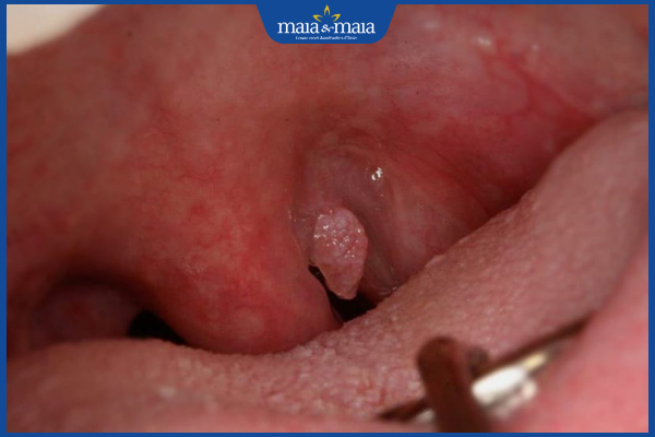 Sùi mào gà ở họng có nguy hiểm không? Điều trị như thế nào? 3 sùi mào gà ở cuống họng