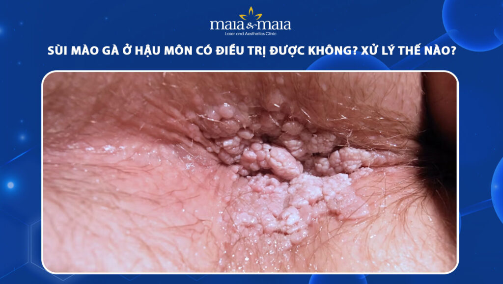 sùi mào gà ở hậu môn