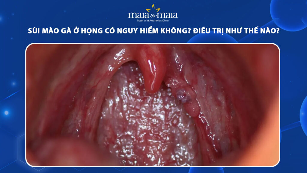 Sùi mào gà ở họng có nguy hiểm không? Điều trị như thế nào? 1 sùi mào gà ở họng
