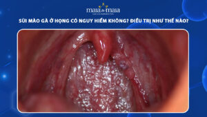 sùi mào gà ở họng