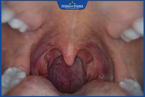 Sùi mào gà ở họng có nguy hiểm không? Điều trị như thế nào? 2 sùi mào gà ở trong họng