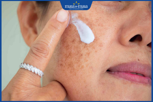 Nám, tàn nhang và đốm nâu khác gì nhau? Cách trị dứt điểm 2 thoa kem trị nám