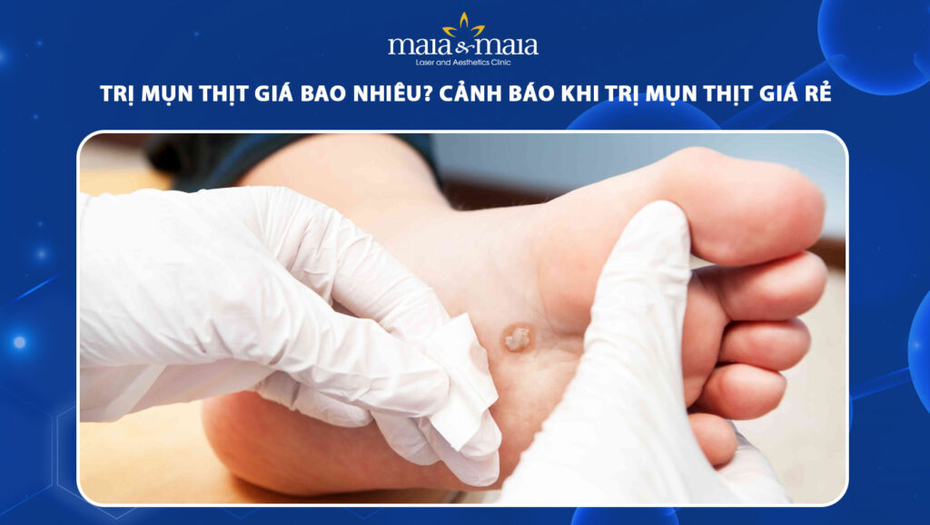 trị mụn thịt giá bao nhiêu