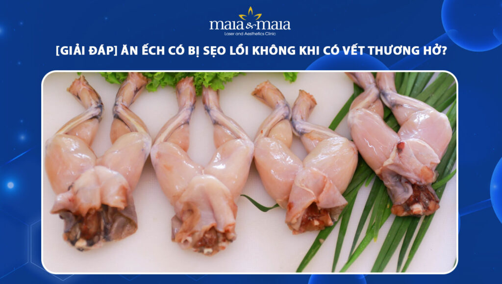 ăn ếch có bị sẹo lồi không