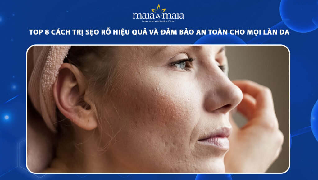 cách trị sẹo rỗ