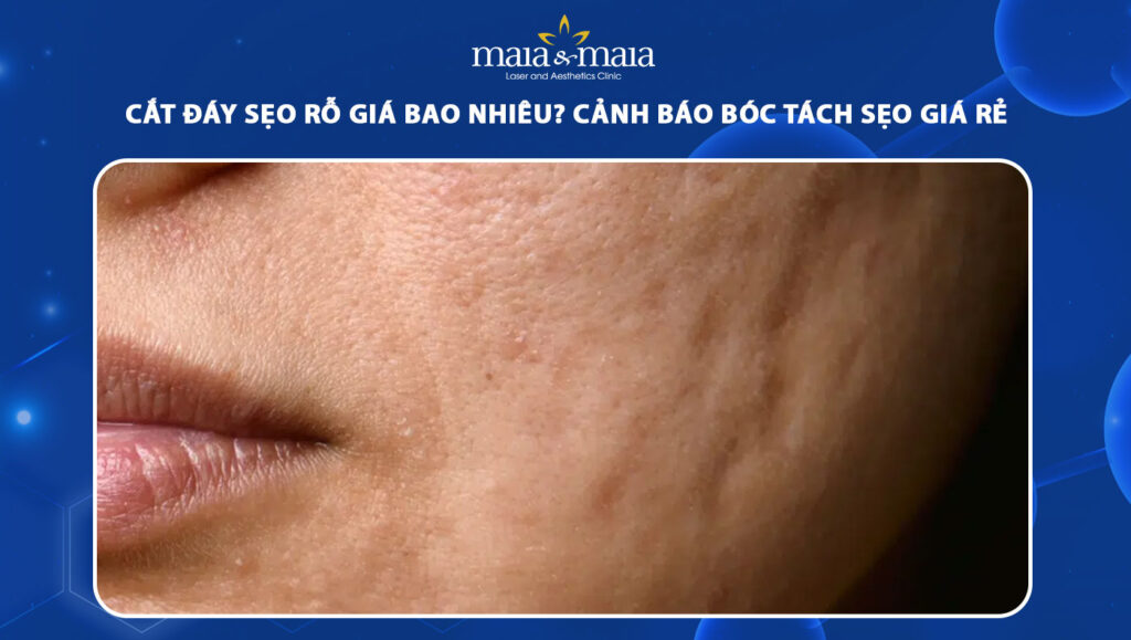 cắt đáy sẹo rỗ giá bao nhiêu