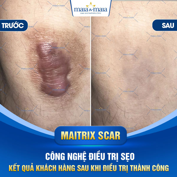 khách hàng trị sẹo lồi tại maia