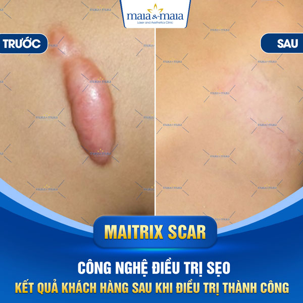 khách trị sẹo lồi tại maia