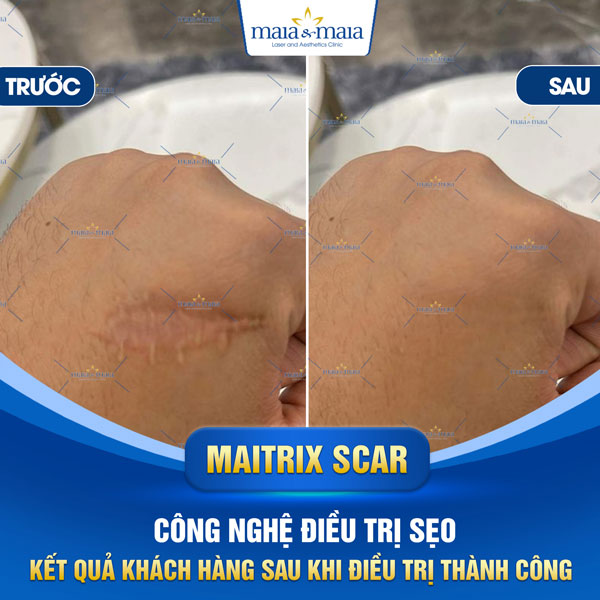 khách trị sẹo lồi