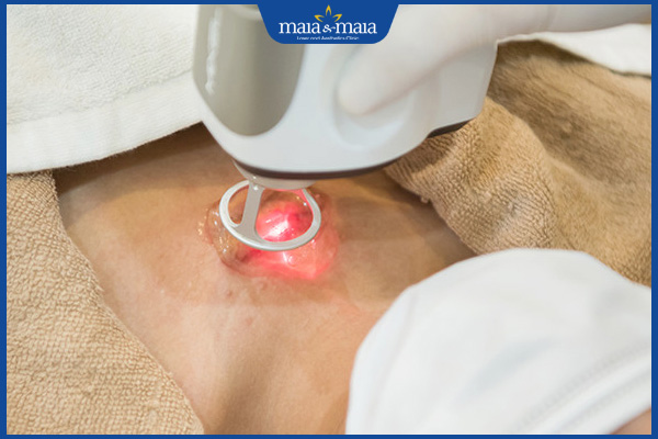 laser trị sẹo lồi