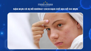 nặn mụn có bị rỗ không