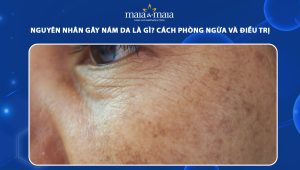 nguyên nhân gây nám da