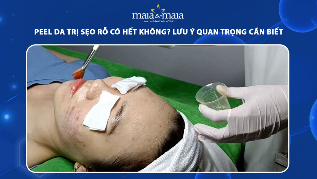 peel da trị sẹo rỗ