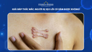 sẹo lồi có xăm được không