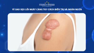 sẹo lồi ngày càng to