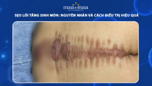 sẹo lồi tầng sinh môn