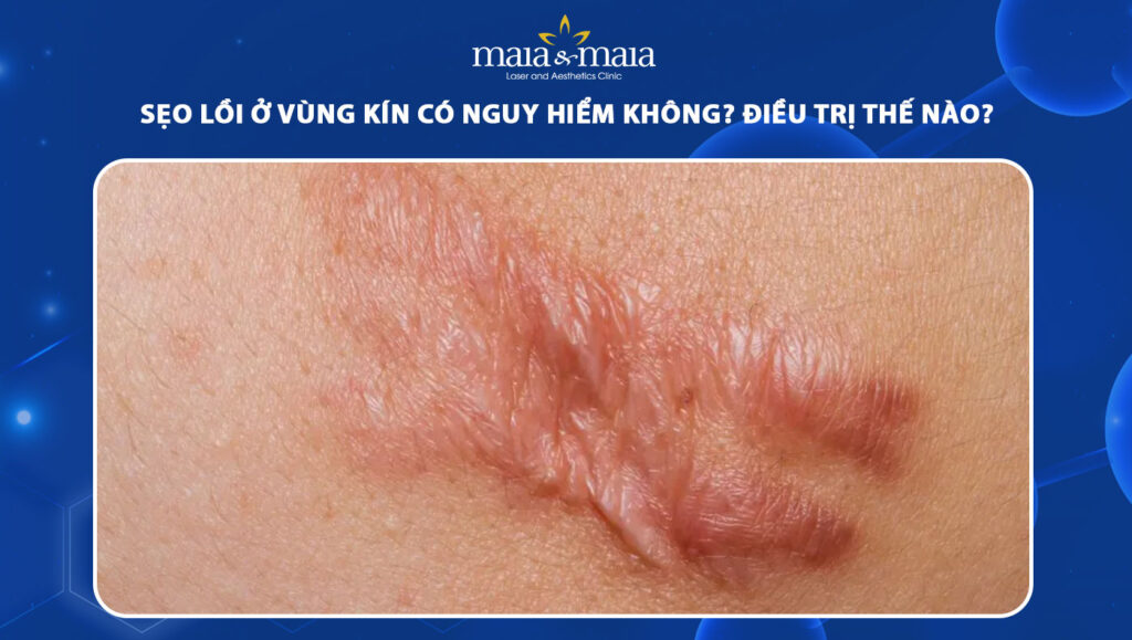 sẹo lồi vùng kín