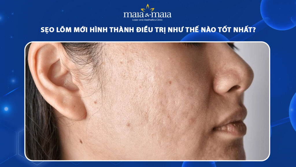 sẹo lõm mới hình thành