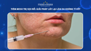 tiêm meso trị sẹo rỗ