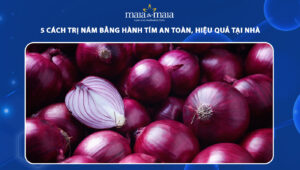 trị nám bằng hành tím