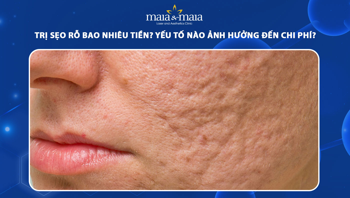 Trị sẹo rỗ bao nhiêu tiền? Yếu tố nào ảnh hưởng tới chi phí?