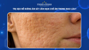 trị sẹo rỗ kiêng ăn gì