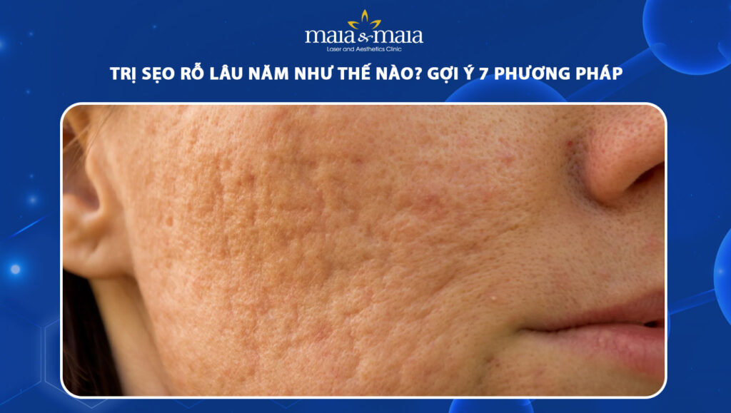 trị sẹo rỗ lâu năm