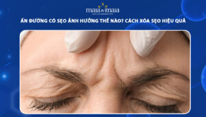 ấn đường có sẹo