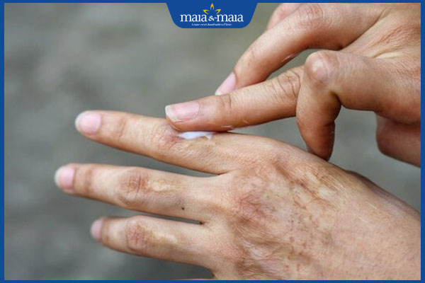 Sẹo bỏng nước sôi: Hậu quả và cách điều trị sẹo dứt điểm 3 bôi kem trị sẹo bỏng nước sôi