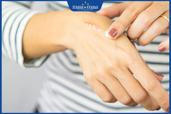 Sẹo bỏng điều trị thế nào? Phòng ngừa vết bỏng thành sẹo 4 bôi kem trị sẹo bỏng