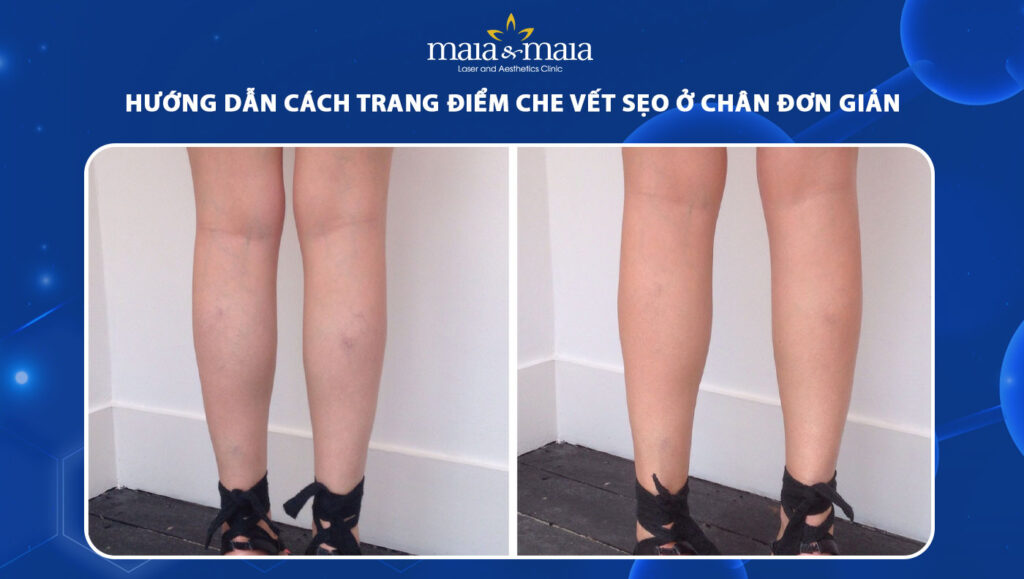 cách trang điểm che vết sẹo ở chân