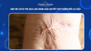 cách trị sẹo lâu năm