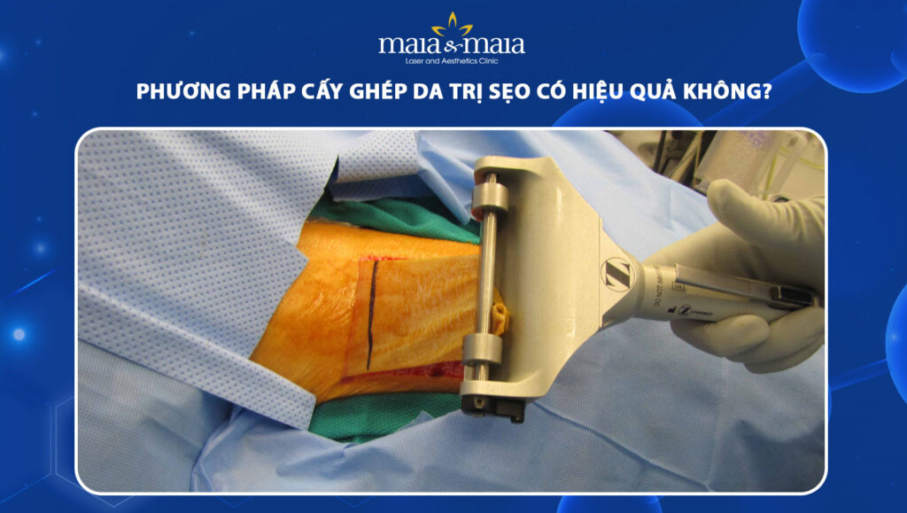 ghép da trị sẹo