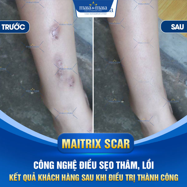 khách trị sẹo thâm thành công