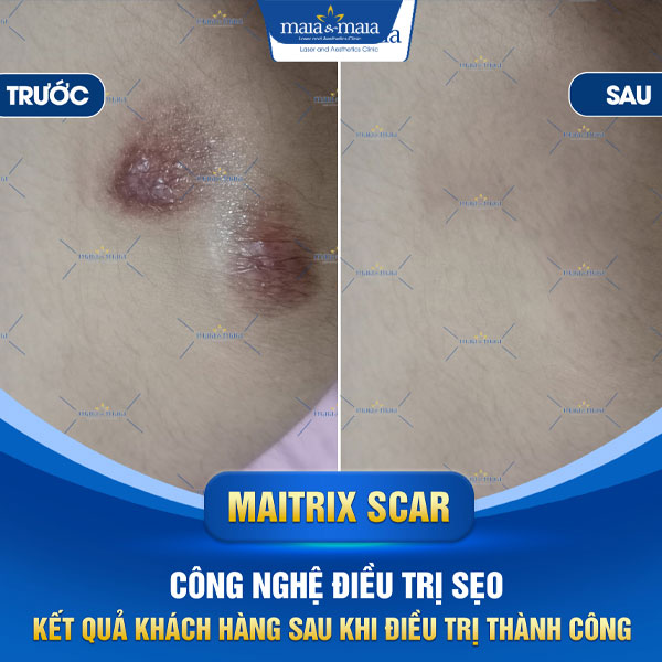 khách trị sẹo thâm