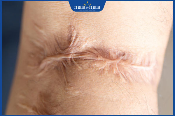 Sẹo bỏng điều trị thế nào? Phòng ngừa vết bỏng thành sẹo 2 nhận biết sẹo bỏng