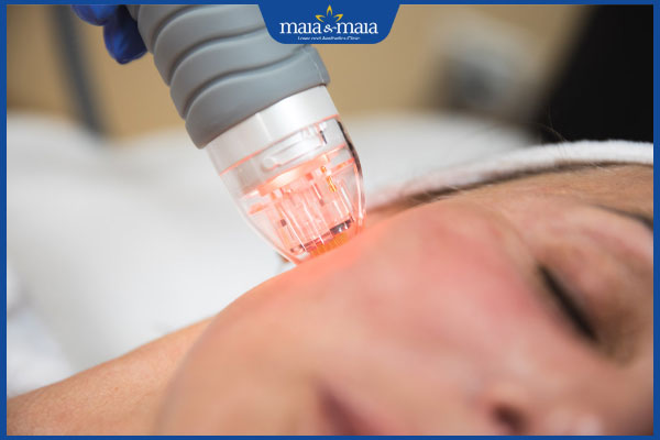 quy trình thực hiện cấy da siêu vi điểm